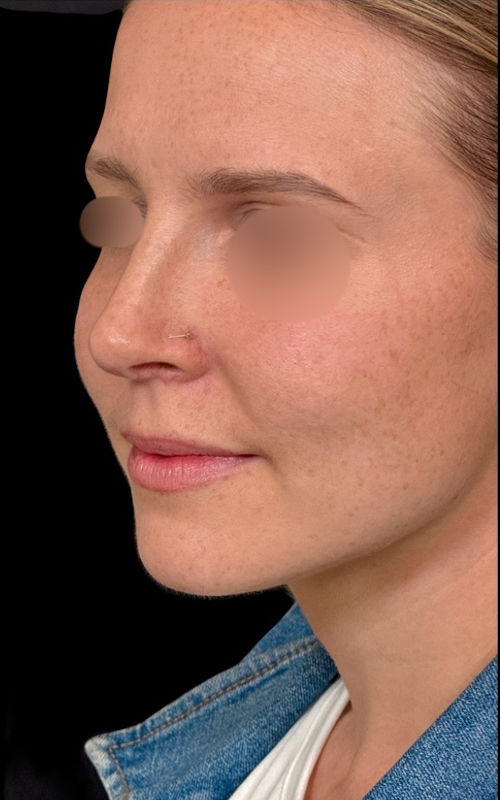 After rhinoplasty angled profile view showing a refined bridge, set-back tip position, and improved nostril proportions.