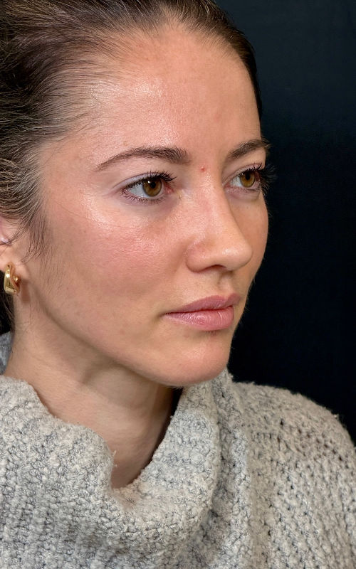 After rhinoplasty angled profile view showing a smoother bridge contour, lifted tip, and improved balance of facial features.