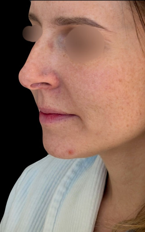 Before rhinoplasty angled profile view showing a projected tip, prominent bridge contour, and elongated nostril appearance.