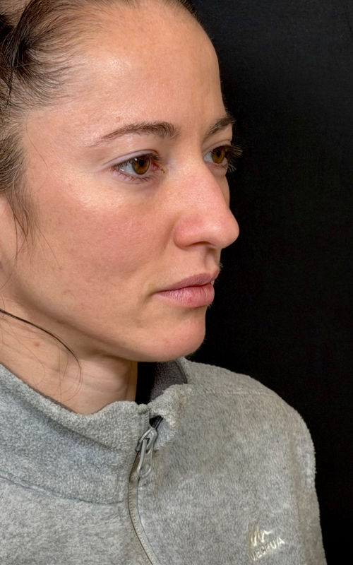 Before rhinoplasty angled profile view showing a prominent bridge, downward tip position, and visible nasal asymmetry.