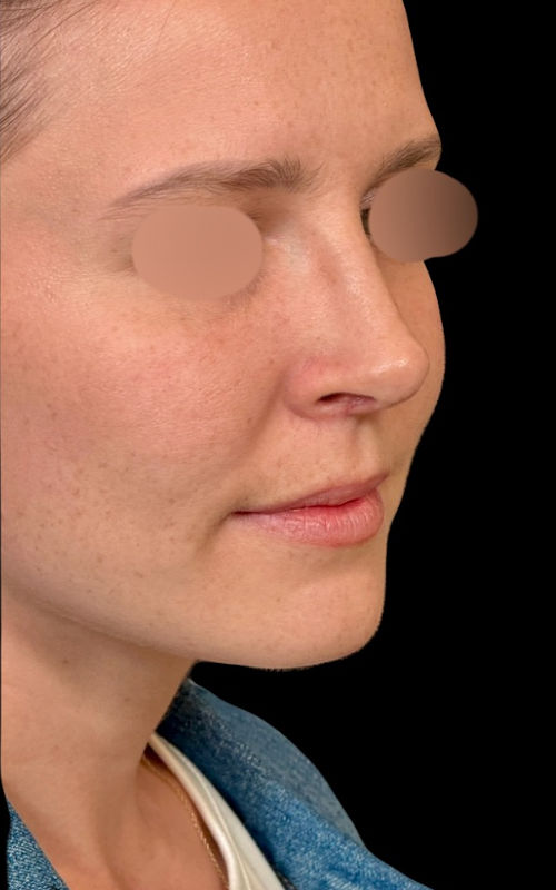 After rhinoplasty angled profile showing a smoother nasal contour, refined tip projection, and reduced nostril show.