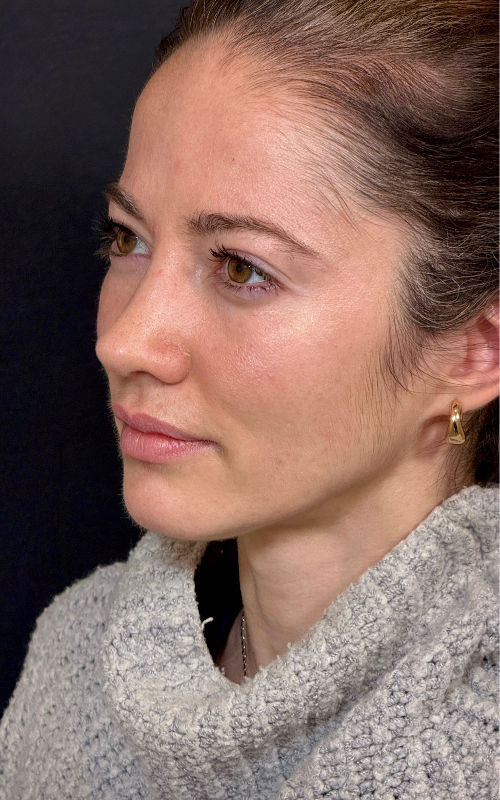 After rhinoplasty angled profile showing a straighter nasal line, refined tip shape, and improved profile harmony.