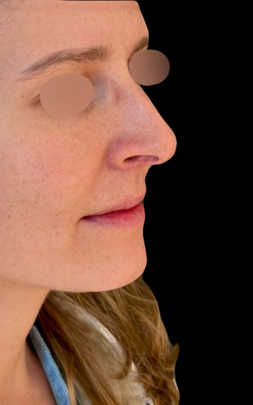 Before rhinoplasty angled profile showing fullness along the bridge, a prominent tip, and increased nostril visibility.