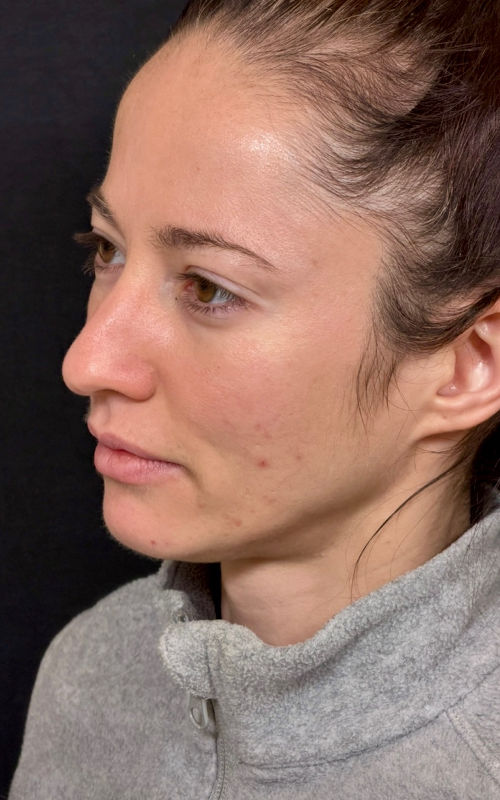 Before rhinoplasty angled profile showing a dorsal hump, tip fullness, and deviation of the nasal structure.