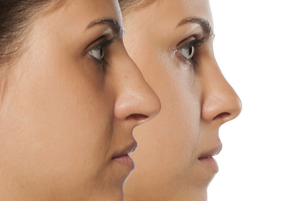 Rhinoplasty in Your 30s vs. 40s vs. 50s
