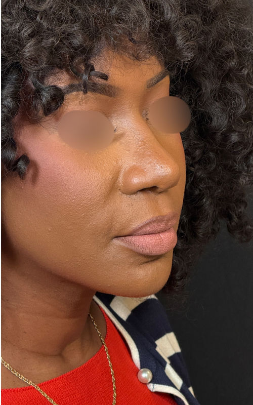 After rhinoplasty angled profile view showing a more defined bridge, refined tip, and narrower nostril width.