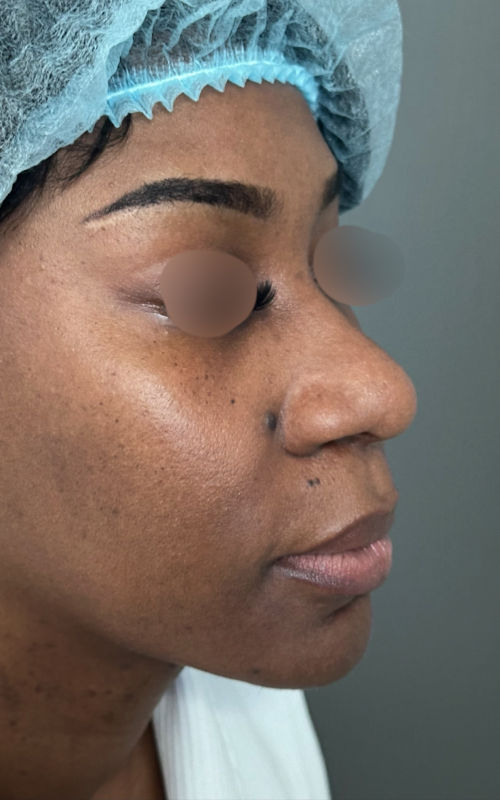Before rhinoplasty angled profile view showing a flatter bridge and wider nostril base.