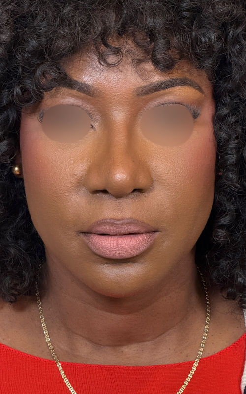 After rhinoplasty front view showing a narrower tip, improved bridge definition, and significantly reduced nostril width.
