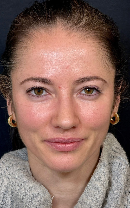 After rhinoplasty front view showing a straighter nose, refined tip definition, and improved facial symmetry.