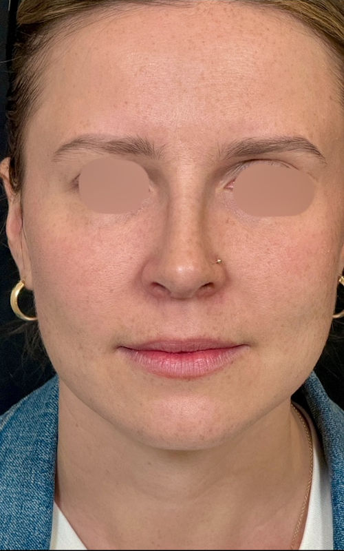 After rhinoplasty front view showing a narrower bridge, refined tip, and improved overall nasal balance.