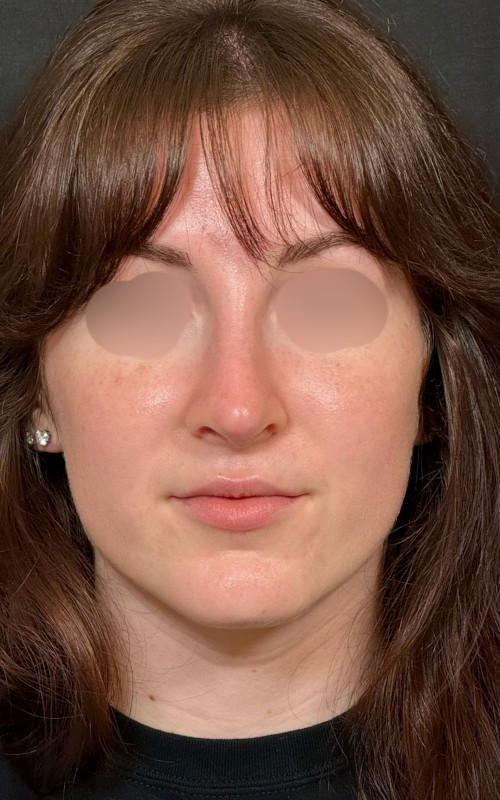 Four months after septorhinoplasty front view showing a straighter nose and improved nasal symmetry.