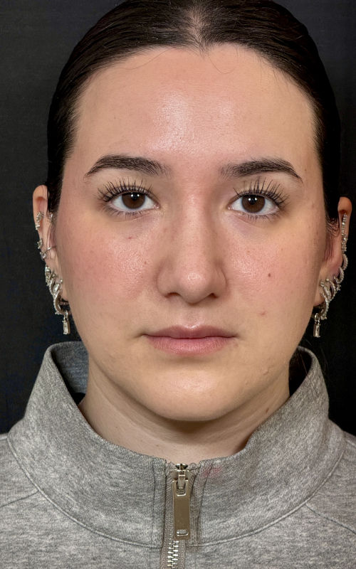 After rhinoplasty front view showing improved nasal symmetry, a more refined tip, and a balanced nasal appearance.