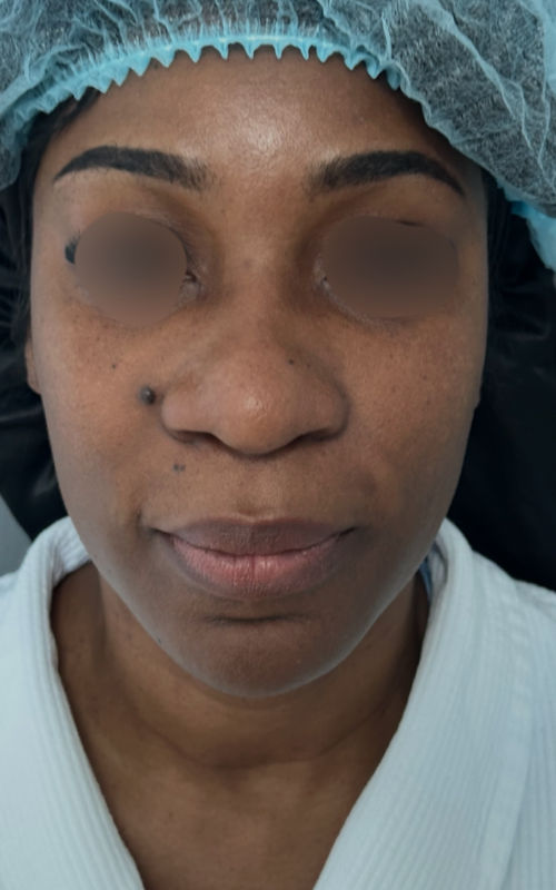 Before rhinoplasty front view showing a broad nasal tip, low bridge, and wider nostril base.
