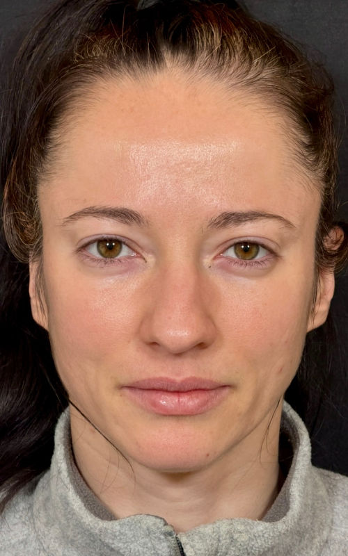 Before rhinoplasty front view showing nasal crookedness, a wider tip, and facial asymmetry caused by nasal deviation.