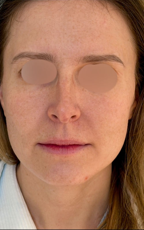 Before rhinoplasty front view showing a wider nasal bridge, fuller tip, and broader nasal appearance.