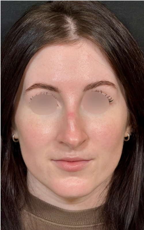 Before septorhinoplasty front view showing nasal asymmetry and deviation of the nasal bridge.