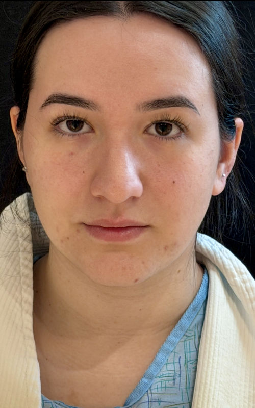 Before rhinoplasty front view showing a fuller nasal tip, mild nasal asymmetry, and less tip definition.