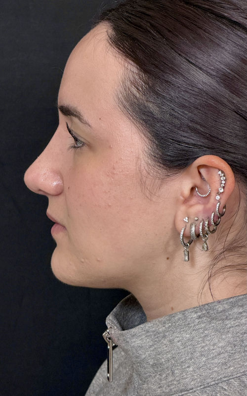 After rhinoplasty left side profile showing hump reduction, improved tip projection, and a more balanced profile.