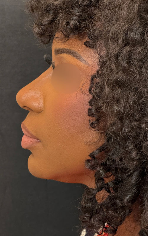 After rhinoplasty left side profile showing improved bridge projection, tip refinement, and a more balanced profile.