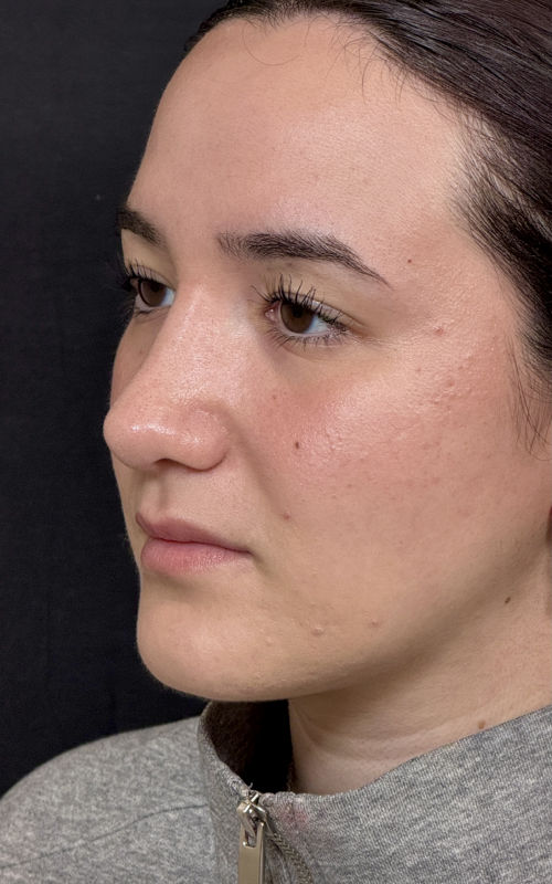 After rhinoplasty left side profile showing hump reduction, improved tip projection, and a more balanced profile.