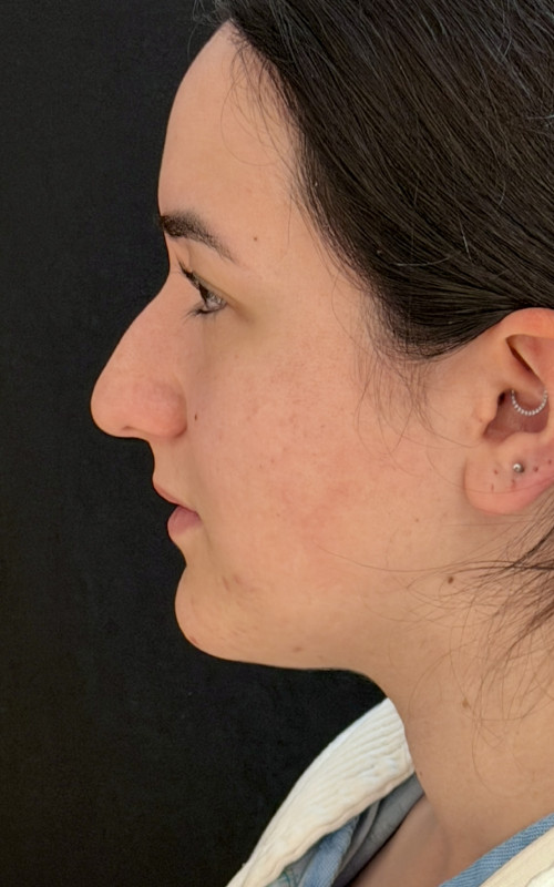 Before rhinoplasty left side profile showing a prominent hump and less refined nasal tip.