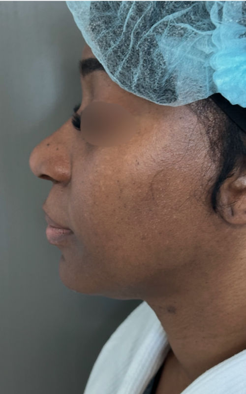 Before rhinoplasty left side profile showing limited bridge height and a broader nasal tip.