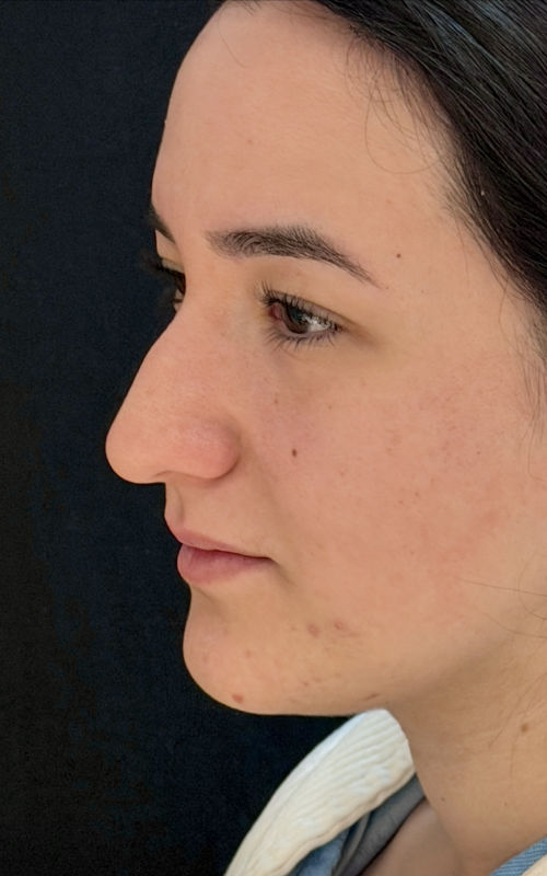 Before rhinoplasty angled profile view showing a fuller bridge and downward tip position.