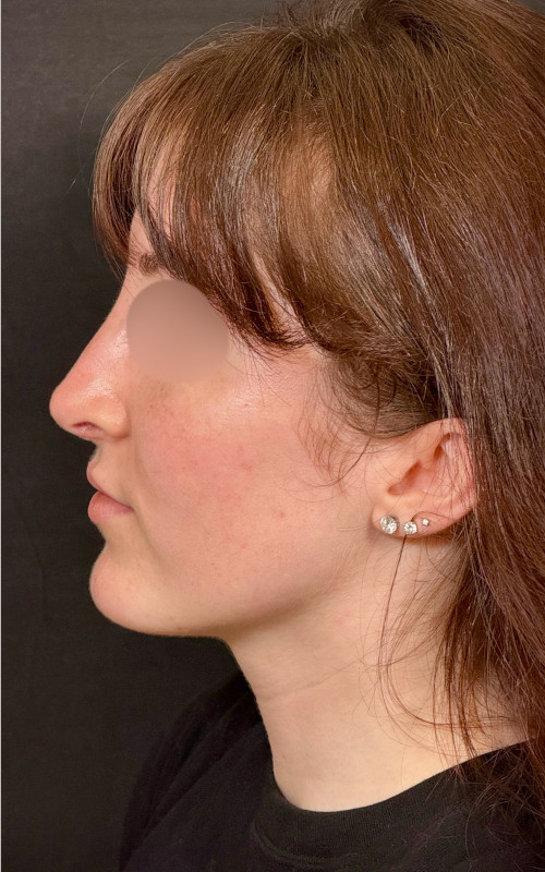 Four months after septorhinoplasty side view showing reduced bridge height, improved alignment, and a lifted tip.