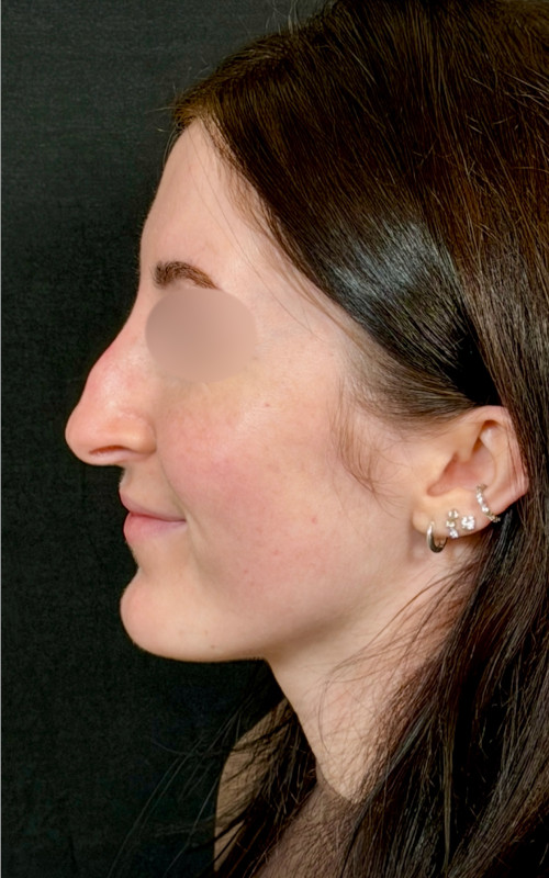 Before septorhinoplasty side view showing bridge prominence and tip droop.