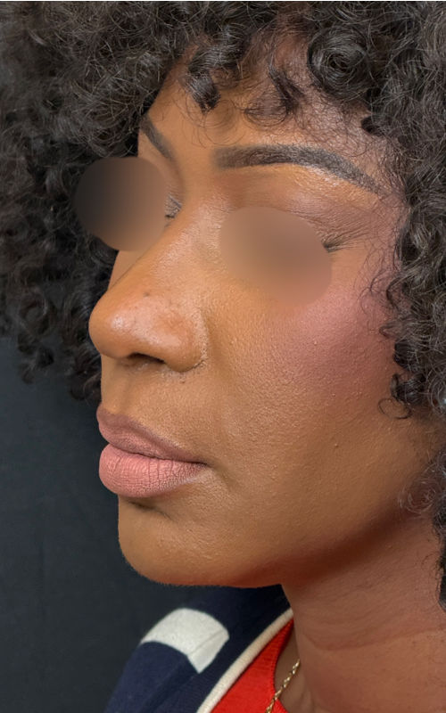 After rhinoplasty angled profile view showing enhanced bridge structure, narrower nostrils, and improved facial harmony.