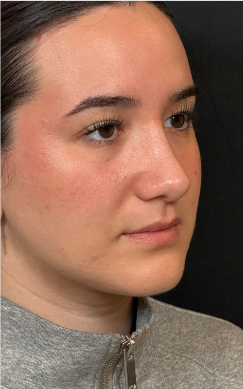 After rhinoplasty three-quarter profile view showing a smoother bridge contour, lifted tip, and more refined nasal shape.