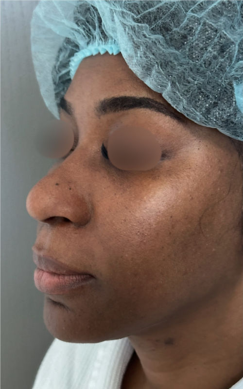Before rhinoplasty angled profile showing a wider nasal base and softer tip definition.