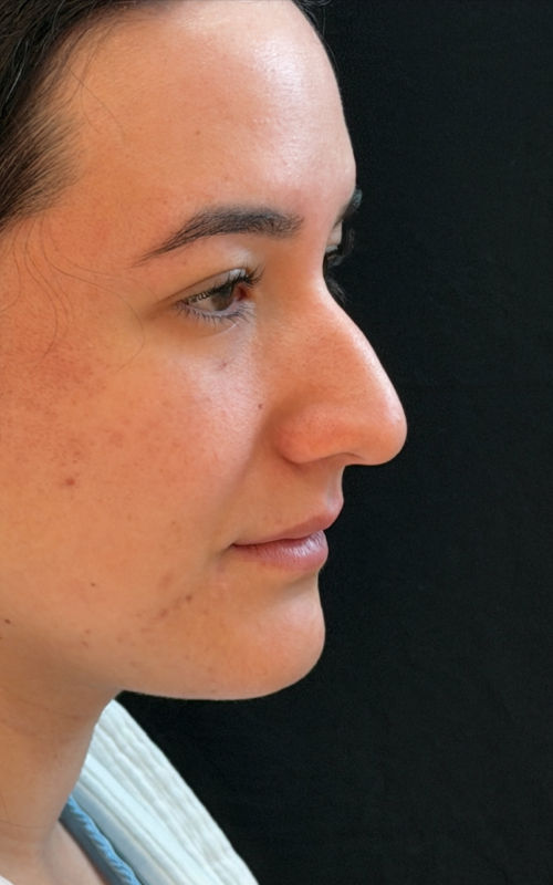 Before rhinoplasty three-quarter profile view showing a prominent nasal hump and limited tip definition.