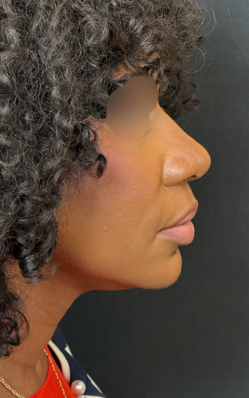 After rhinoplasty side profile showing an augmented bridge, narrower tip, and improved nasal definition.