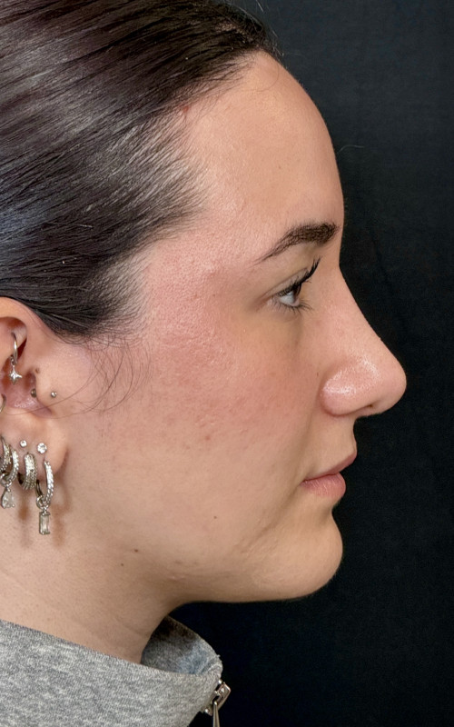 After rhinoplasty side profile showing a smoother bridge, lifted tip, and softer nasal contour.