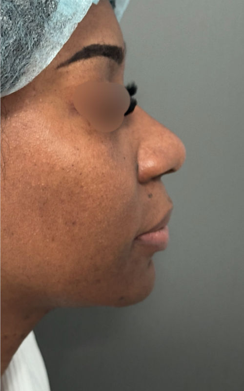 Before rhinoplasty side profile showing a low nasal bridge, wider tip, and less nasal projection.