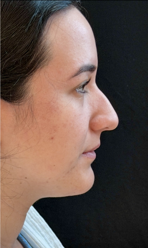 Before rhinoplasty side profile showing a dorsal hump, drooping nasal tip, and heavier nasal profile.