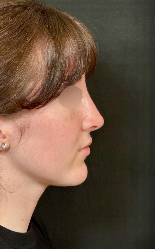 Four months after septorhinoplasty showing a straighter bridge, refined profile, and elevated nasal tip with improved facial balance.