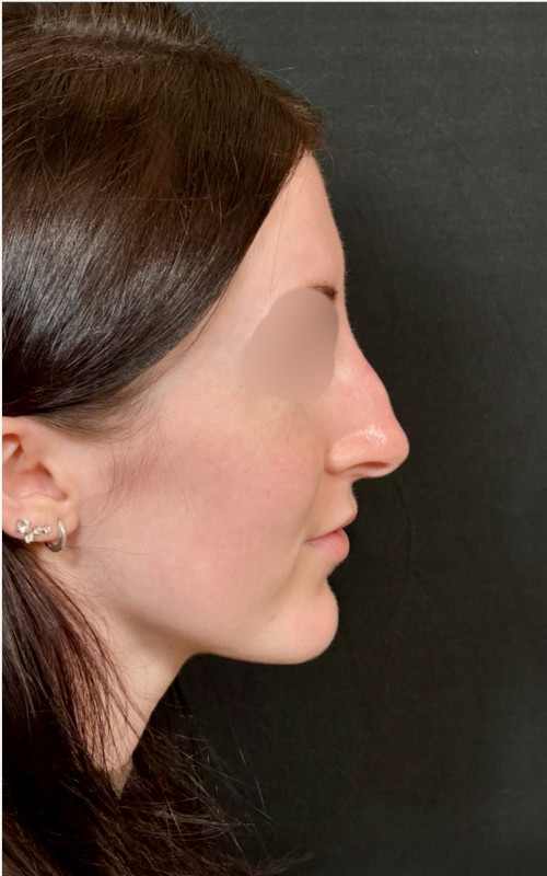 Before septorhinoplasty showing a dorsal hump, slight nasal deviation, and a drooping nasal tip from the side profile.
