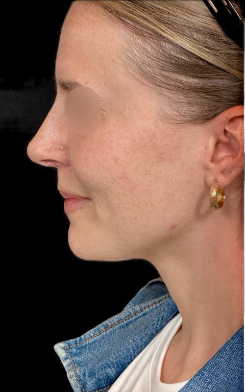 After rhinoplasty side profile showing a smoother bridge, reduced sidewall prominence, and less visible nostril show.