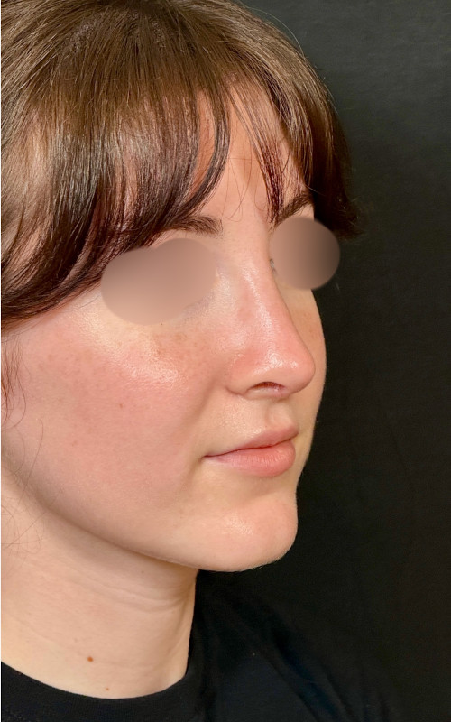 Four months after septorhinoplasty angled view showing a smoother bridge and refined tip contour.
