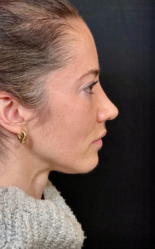 After rhinoplasty side profile showing a smoother bridge, lifted tip, and improved nasal alignment.