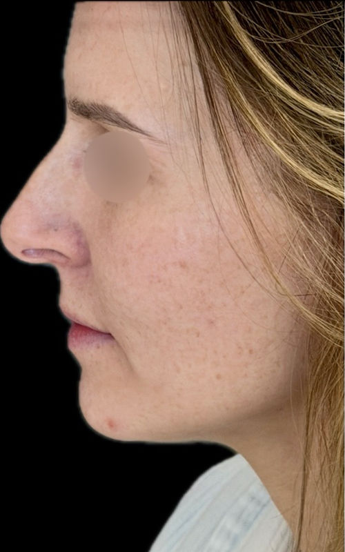 Before rhinoplasty side profile showing a prominent bridge, visible sidewall fullness, and increased nostril show.
