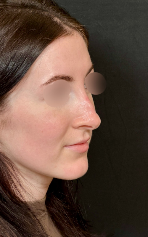 Before septorhinoplasty angled view showing a prominent hump and downward tip position.