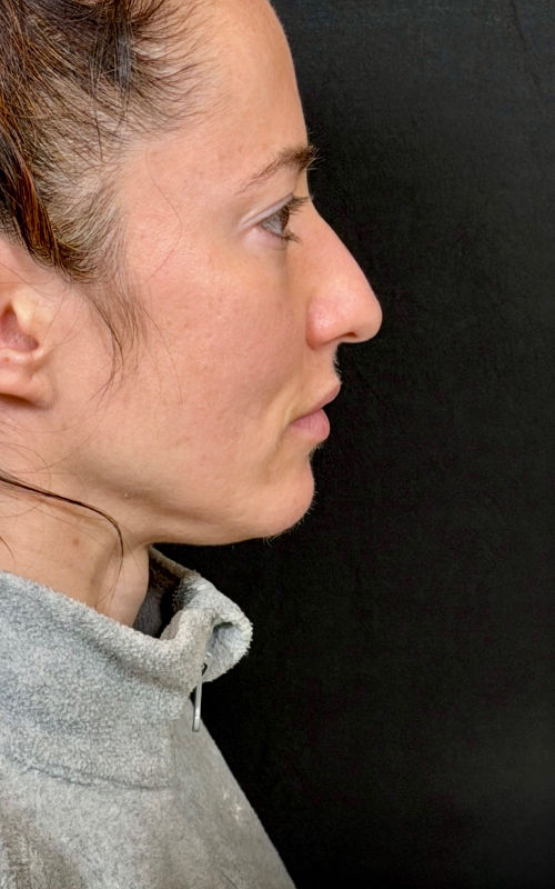 Before rhinoplasty side profile showing a prominent nasal bridge, drooping tip, and mild nasal deviation.