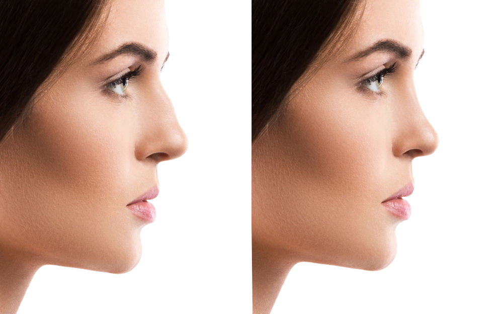 Primary vs Revision Rhinoplasty