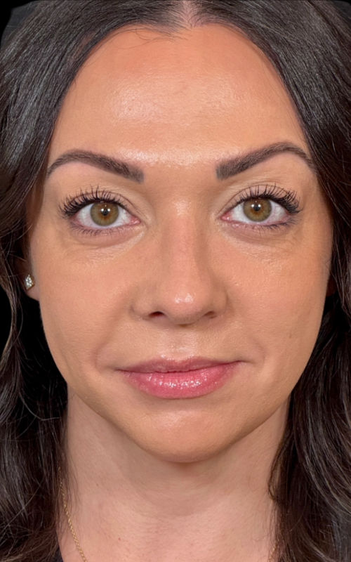 After rhinoplasty front view showing improved nasal symmetry, straighter alignment, and natural facial harmony.