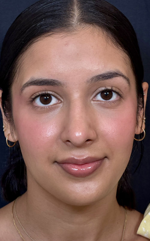 Four months after septorhinoplasty front view showing improved nasal symmetry and straighter alignment.