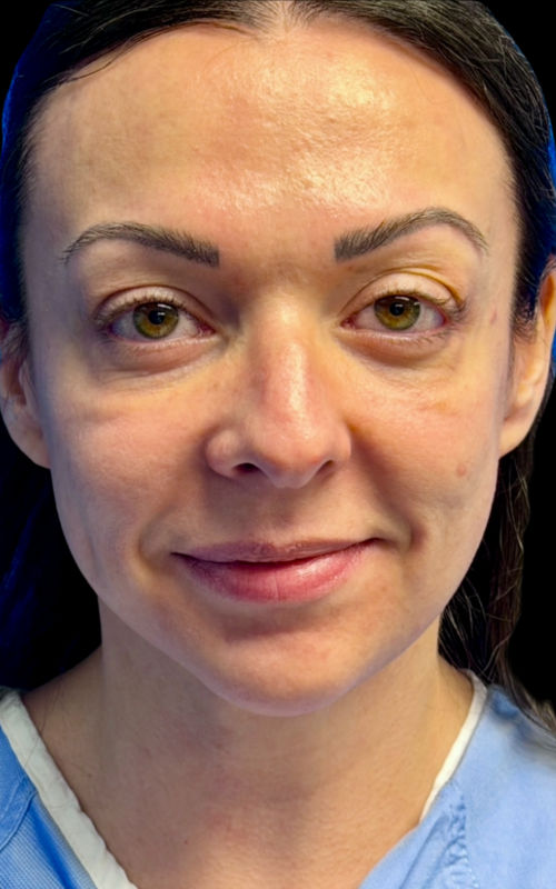 Before rhinoplasty front view showing mild nasal asymmetry and slight deviation.