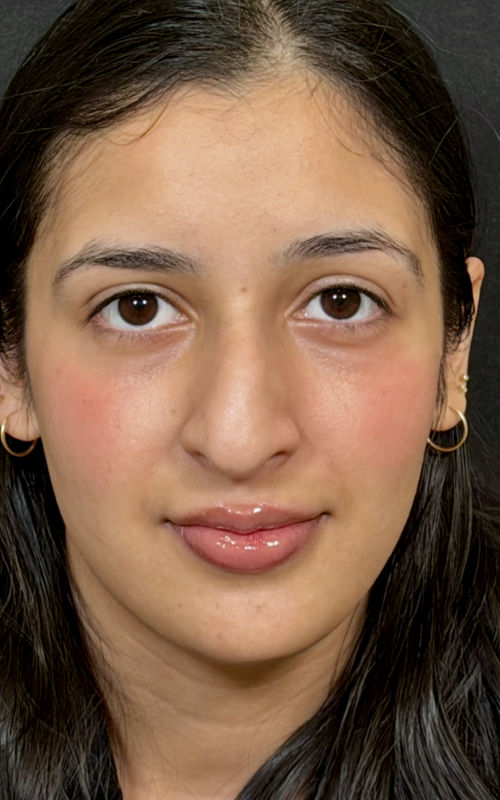 Before septorhinoplasty front view showing mild nasal deviation and asymmetry.